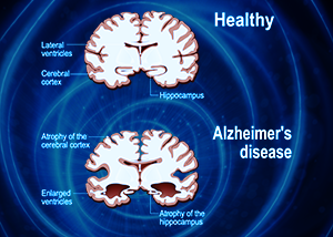 MCTs Accelerate Neurodegeneration