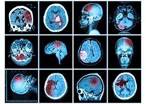 MCTs Increase Inflammation